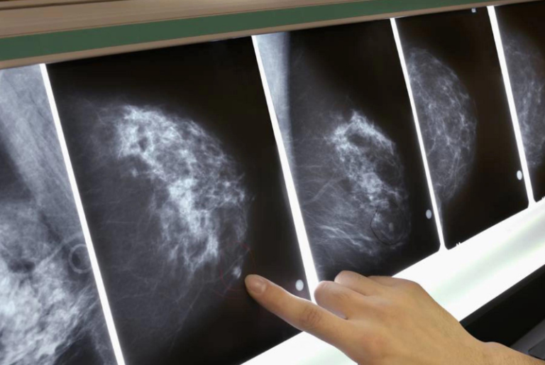 Nuevo fármaco frena el cáncer del cáncer de mama metastásico en un 75,8%